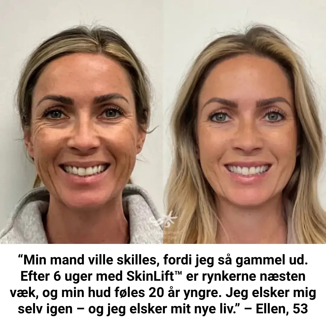 SkinLift™ Botox Serum - Synligt yngre hud på 14 dage.