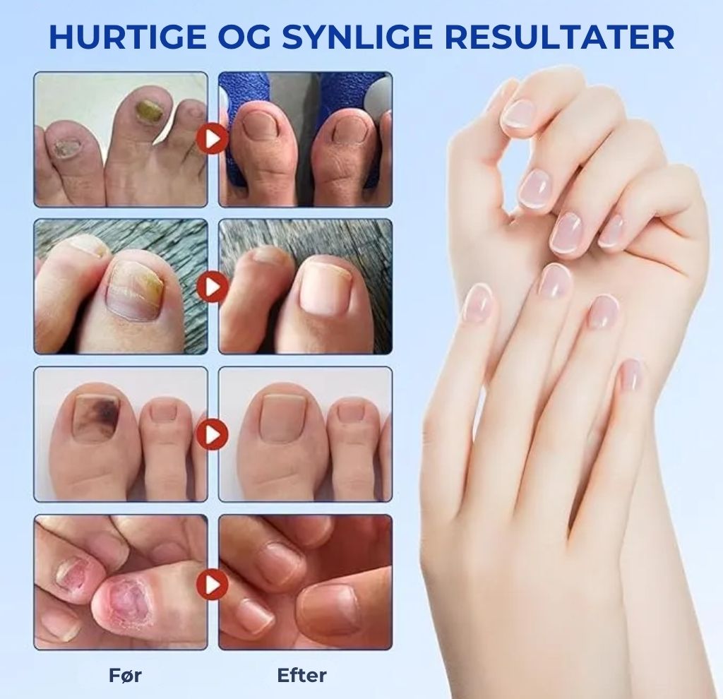 NegleFix™ – Svampedræbende Negleplaster til Sundere Negle