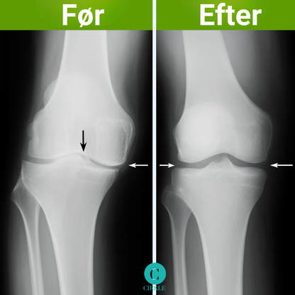 KnæKomfort™ | Stop stivheden i knæene og bevæg dig frit uden smerter