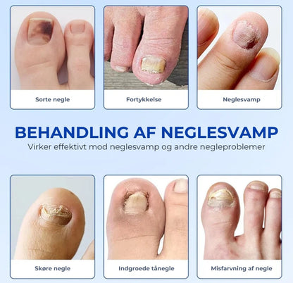 NegleFix™ – Svampedræbende Negleplaster til Sundere Negle