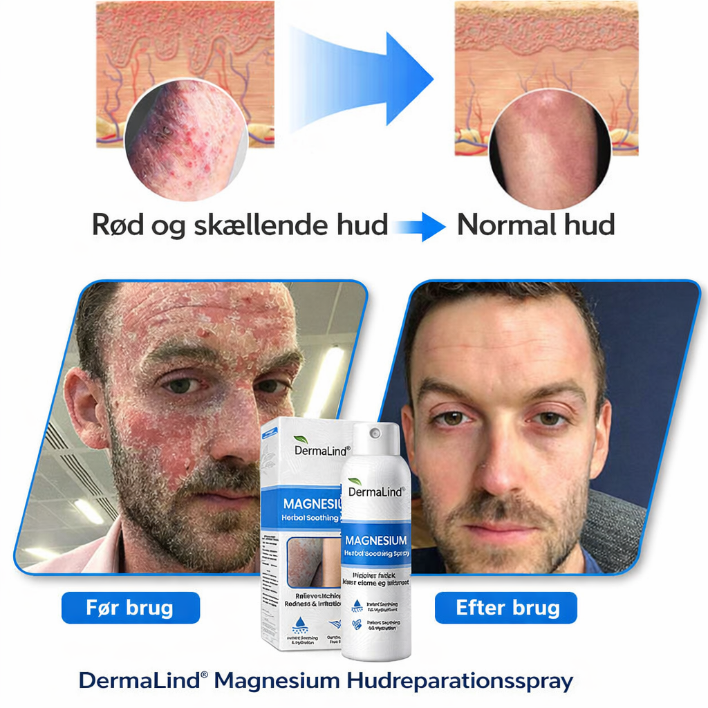 DermaLind™ - Magnesium Hudreparerende Spray til Sensitiv og Irriteret Hud