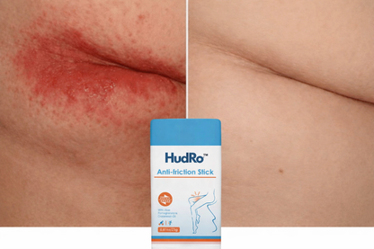 HudRo™ – Anti-friktions stick til irriteret hud