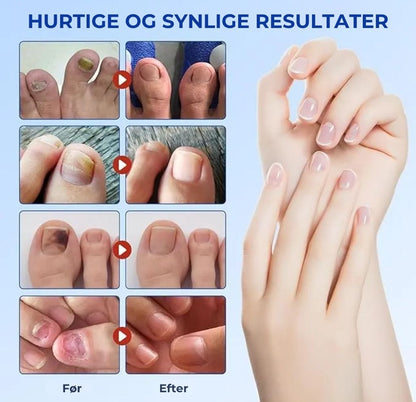 NegleFix™ – Svampedræbende Negleplaster til Sundere Negle