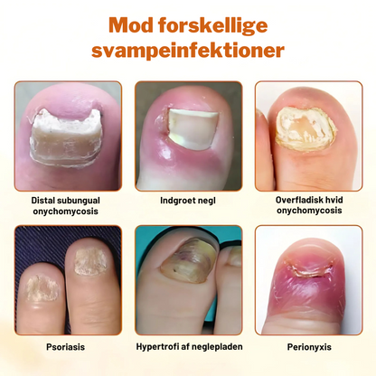 KlarNegl™ – Avanceret Svampedræbende Negleplejespray